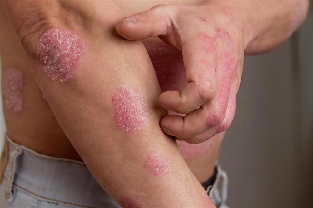 Clinical assessment for psoriasis in a primary care setting