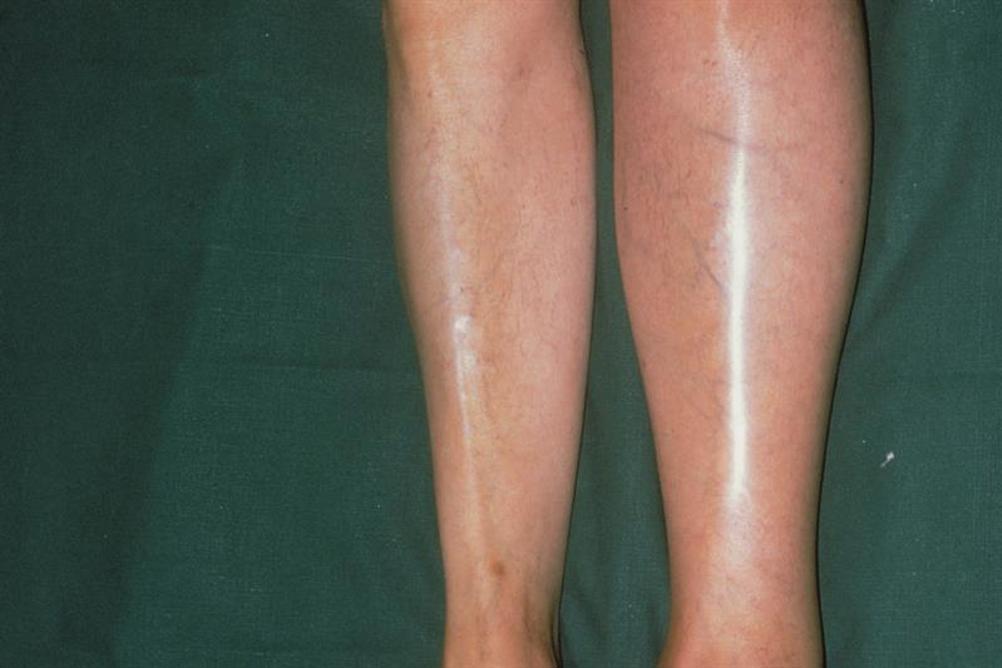 Reducing Cellulitis with Compression Therapy