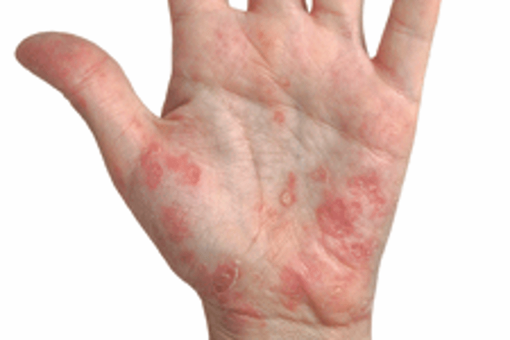 https://www.independentnurse.co.uk/media/pwmpkaoq/hand-eczema.gif?width=1002&height=668&bgcolor=White&rnd=133205161523700000