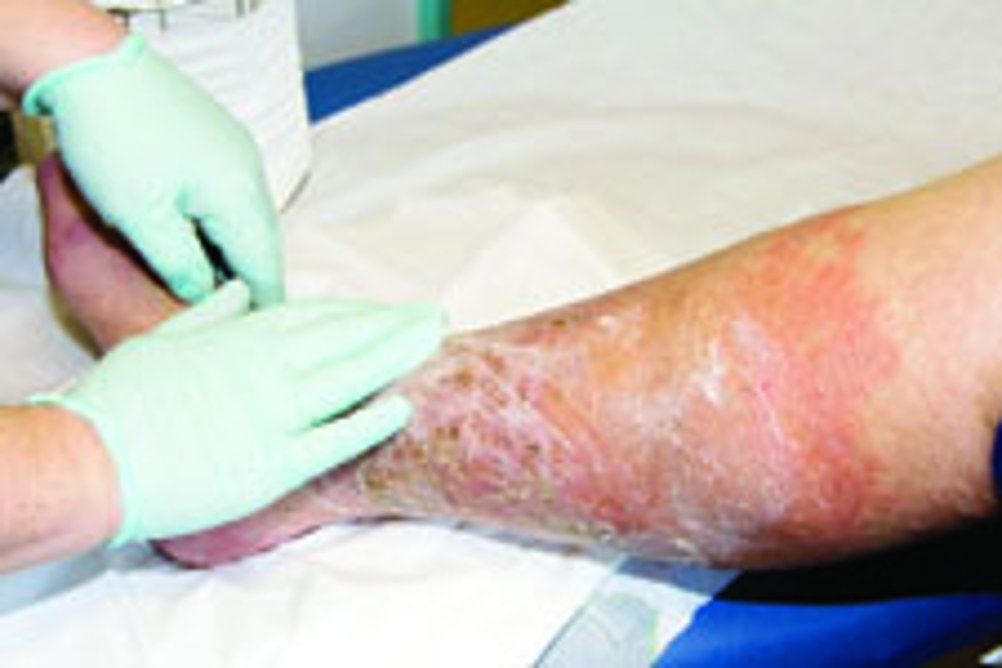 How Compression Therapy Enhances Wound Healing