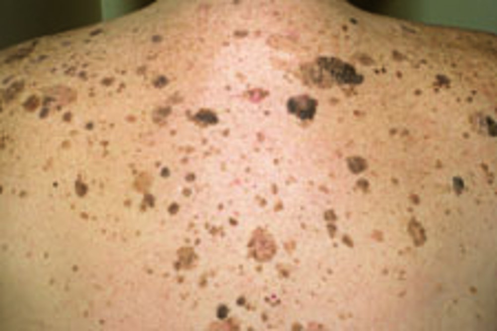 Identifying common lesions and rashes in elderly people