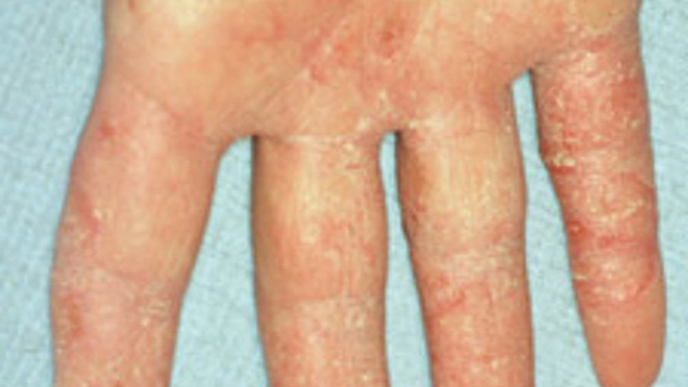 skin rashes on hands